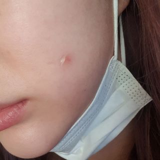 히루스카 포스트아크네 클리어 — 4점을 준 리뷰어가 2021년 1월 올린 사용 사진