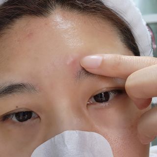 세뚜아(Cettua) 세뚜아 스팟 클리어 듀얼 패치 Cettua Spot Clear Dual Patch — 5점을 준 리뷰어가 2023년 6월 올린 사용 사진