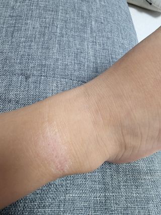젠바이오 코스메틱스 젠바이오수딩크림]   가려운 피부 & 아토피 원픽 크림 — 5점을 준 리뷰어가 2022년 7월 올린 사용 사진