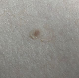 히루스카 포스트아크네 클리어 — 4.5점을 준 리뷰어가 2021년 1월 올린 사용 사진