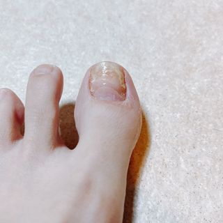 유케어 YOU CARE 문제성 손발톱케어_럭키풋 — 5점을 준 리뷰어가 2022년 10월 올린 사용 사진