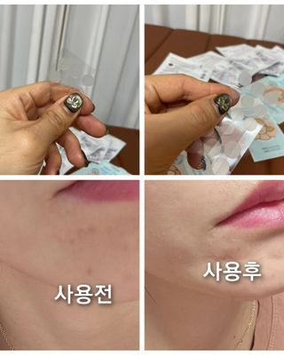 세뚜아(Cettua) 세뚜아 스팟 클리어 듀얼 패치 Cettua Spot Clear Dual Patch — 5점을 준 리뷰어가 2023년 11월 올린 사용 사진