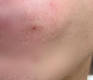 3M 넥스케어 블레미쉬 여드름패치 릴리프 111매(짜기 전 케어) +알코올스왑 증정 — 5점을 준 리뷰어가 2024년 5월 올린 사용 사진