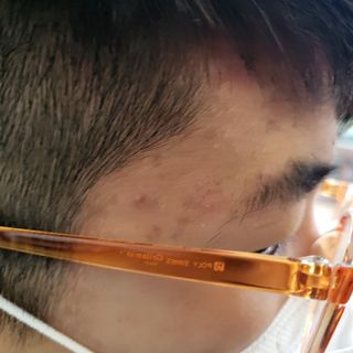 에버렐 아크네 클리어 패치 오리지널(40매) + XL(8매) 1세트, 각 1개씩 — 5점을 준 리뷰어가 2022년 5월 올린 사용 사진