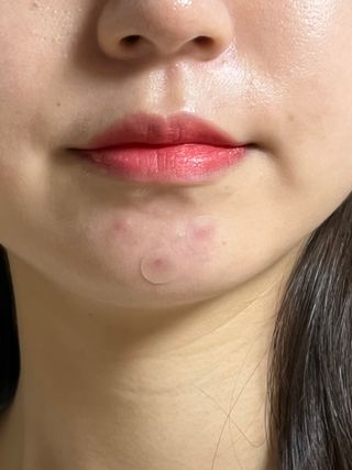 세뚜아(Cettua) 세뚜아 스팟 클리어 듀얼 패치 Cettua Spot Clear Dual Patch — 5점을 준 리뷰어가 2023년 9월 올린 사용 사진