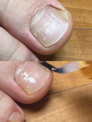 유케어 YOU CARE 문제성 손발톱케어_럭키풋 — 5점을 준 리뷰어가 2022년 10월 올린 사용 사진