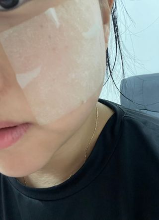 [후르디아] 화난피부 급속진정 AC 클리어 패드 (개별포장 50매) — 5점을 준 리뷰어가 2024년 4월 올린 사용 사진