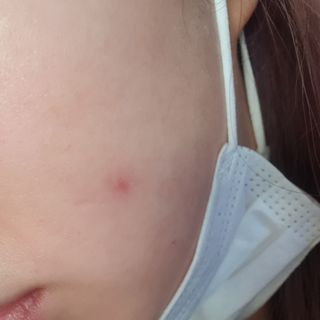 히루스카 포스트아크네 클리어 — 4점을 준 리뷰어가 2021년 1월 올린 사용 사진