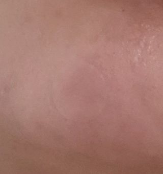 [큐어반H 스팟] 자외선 99프로 차단되는 스틱타입 스팟밴드(1팩 / 66매입) — 5점을 준 리뷰어가 2022년 11월 올린 사용 사진