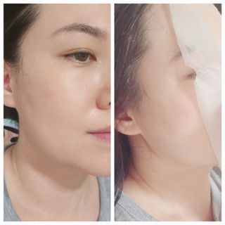 세뚜아(Cettua) 세뚜아 스팟 클리어 듀얼 패치 Cettua Spot Clear Dual Patch — 4.5점을 준 리뷰어가 2023년 9월 올린 사용 사진