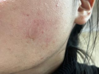 마이디플러스 트리플부스팅, 트러블 릴리프 케어 마이크로 패치 2종 중 택1 — 5점을 준 리뷰어가 2021년 11월 올린 사용 사진