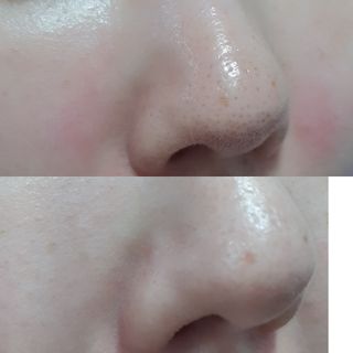 [후르디아] 저자극 필오프팩, 청포도 노즈팩 — 4점을 준 리뷰어가 2023년 8월 올린 사용 사진