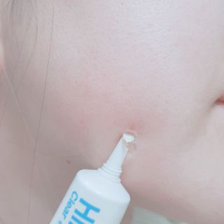 히루스카 포스트아크네 클리어 — 5점을 준 리뷰어가 2021년 2월 올린 사용 사진
