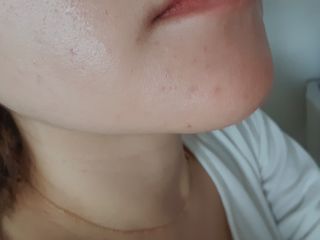 히루스카 포스트아크네 클리어 — 5점을 준 리뷰어가 2021년 1월 올린 사용 사진