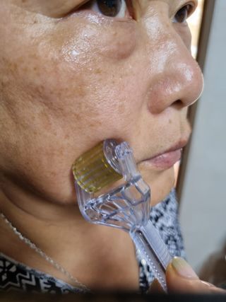 퍼퓸홀릭 [보툴리늄 원액] 7일의 변화 메디-보툴리늄 — 5점을 준 리뷰어가 2021년 9월 올린 사용 사진