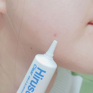 히루스카 포스트아크네 클리어 — 5점을 준 리뷰어가 2021년 2월 올린 사용 사진
