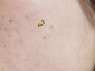 세뚜아(Cettua) 세뚜아 스팟 클리어 듀얼 패치 Cettua Spot Clear Dual Patch — 5점을 준 리뷰어가 2023년 8월 올린 사용 사진