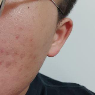 히루스카 포스트아크네 클리어 — 4점을 준 리뷰어가 2021년 1월 올린 사용 사진