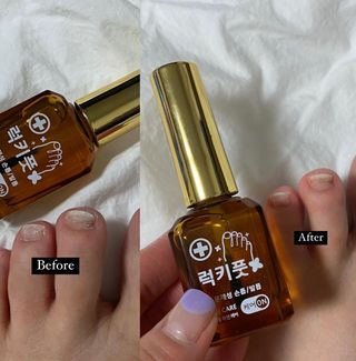 유케어 YOU CARE 문제성 손발톱케어_럭키풋 — 5점을 준 리뷰어가 2022년 10월 올린 사용 사진