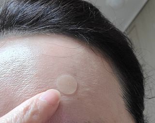 세뚜아(Cettua) 세뚜아 스팟 클리어 듀얼 패치 Cettua Spot Clear Dual Patch — 5점을 준 리뷰어가 2023년 5월 올린 사용 사진