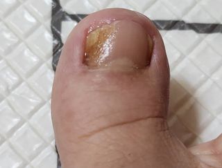 유케어 YOU CARE 문제성 손발톱케어_럭키풋 — 4.5점을 준 리뷰어가 2022년 10월 올린 사용 사진