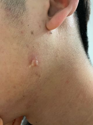 히루스카 포스트아크네 클리어 — 5점을 준 리뷰어가 2021년 2월 올린 사용 사진