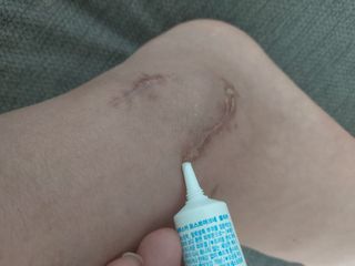 히루스카 포스트아크네 클리어 — 5점을 준 리뷰어가 2021년 2월 올린 사용 사진