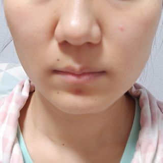 메디미케이알 커핑테라피 실리콘부항마사지 리프팅 페이스+바디 안티 셀룰 라이트 6pcs — 5점을 준 리뷰어가 2021년 2월 올린 사용 사진