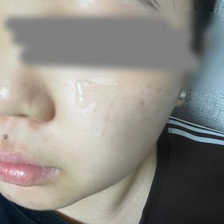 나나스킨 콤플렉스씨쓰리닥터클리어앰플 — 5점을 준 리뷰어가 2021년 11월 올린 사용 사진