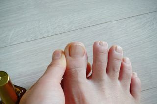 유케어 YOU CARE 문제성 손발톱케어_럭키풋 — 4.5점을 준 리뷰어가 2022년 10월 올린 사용 사진