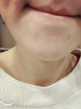 히루스카 포스트아크네 클리어 — 4점을 준 리뷰어가 2021년 1월 올린 사용 사진