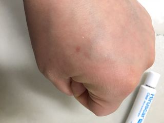 히루스카 포스트아크네 클리어 — 5점을 준 리뷰어가 2021년 1월 올린 사용 사진