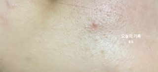 세뚜아(Cettua) 세뚜아 스팟 클리어 듀얼 패치 Cettua Spot Clear Dual Patch — 5점을 준 리뷰어가 2023년 8월 올린 사용 사진