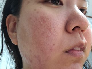 베지톨로지 비니페린 브라이트닝 앰플 — 5점을 준 리뷰어가 2022년 9월 올린 사용 사진