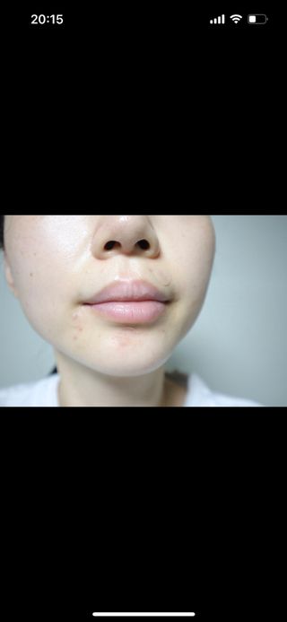 세뚜아(Cettua) 세뚜아 스팟 클리어 듀얼 패치 Cettua Spot Clear Dual Patch — 4.5점을 준 리뷰어가 2023년 7월 올린 사용 사진