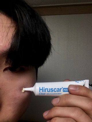 히루스카 포스트아크네 클리어 — 4.5점을 준 리뷰어가 2021년 2월 올린 사용 사진