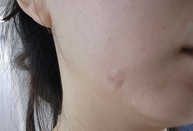 세뚜아 스팟 클리어 듀얼 패치 Cettua Spot Clear Dual Patch 리뷰 사진