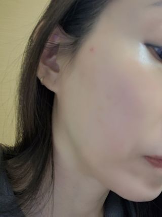 히루스카 포스트아크네 클리어 — 5점을 준 리뷰어가 2021년 1월 올린 사용 사진