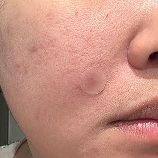 세뚜아(Cettua) 세뚜아 스팟 클리어 듀얼 패치 Cettua Spot Clear Dual Patch — 4.5점을 준 리뷰어가 2023년 8월 올린 사용 사진