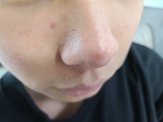 히루스카 포스트아크네 클리어 — 5점을 준 리뷰어가 2021년 1월 올린 사용 사진
