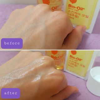 바이오오일 [바이오-오일] 스킨케어 오일 내추럴 60ml — 4.5점을 준 리뷰어가 2021년 12월 올린 사용 사진