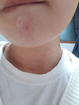 히루스카 포스트아크네 클리어 — 5점을 준 리뷰어가 2021년 2월 올린 사용 사진