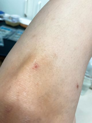 [큐어반H 커팅] 간편하게 떼서 쓰는 자외선차단 습윤밴드 (1팩/30매입) — 4.5점을 준 리뷰어가 2022년 11월 올린 사용 사진