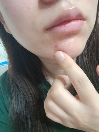 히루스카 포스트아크네 클리어 — 5점을 준 리뷰어가 2021년 2월 올린 사용 사진