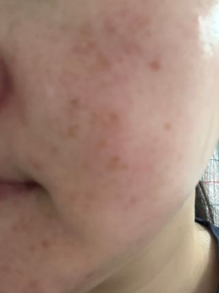 [쿠팡●구매평] 닥터초이스 디판테놀 시카 만능 버블토너 150ml — 5점을 준 리뷰어가 2025년 7월 올린 사용 사진