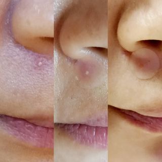 세뚜아(Cettua) 세뚜아 스팟 클리어 듀얼 패치 Cettua Spot Clear Dual Patch — 5점을 준 리뷰어가 2023년 7월 올린 사용 사진