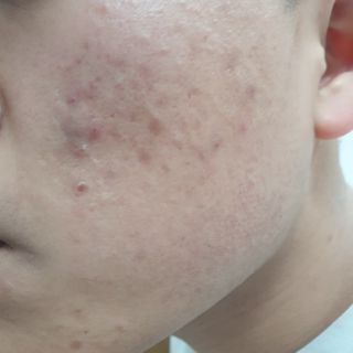 히루스카 포스트아크네 클리어 — 4점을 준 리뷰어가 2021년 1월 올린 사용 사진