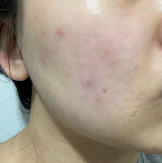 히루스카 포스트아크네 클리어 — 4점을 준 리뷰어가 2021년 2월 올린 사용 사진