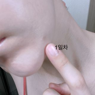 히루스카 포스트아크네 클리어 — 5점을 준 리뷰어가 2021년 2월 올린 사용 사진