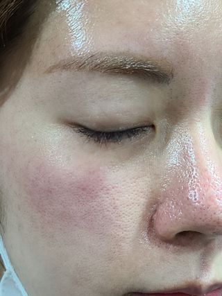 랑팡 EGF+FGF 10ppm 리포좀 앰플 원액 10ml — 5점을 준 리뷰어가 2021년 11월 올린 사용 사진